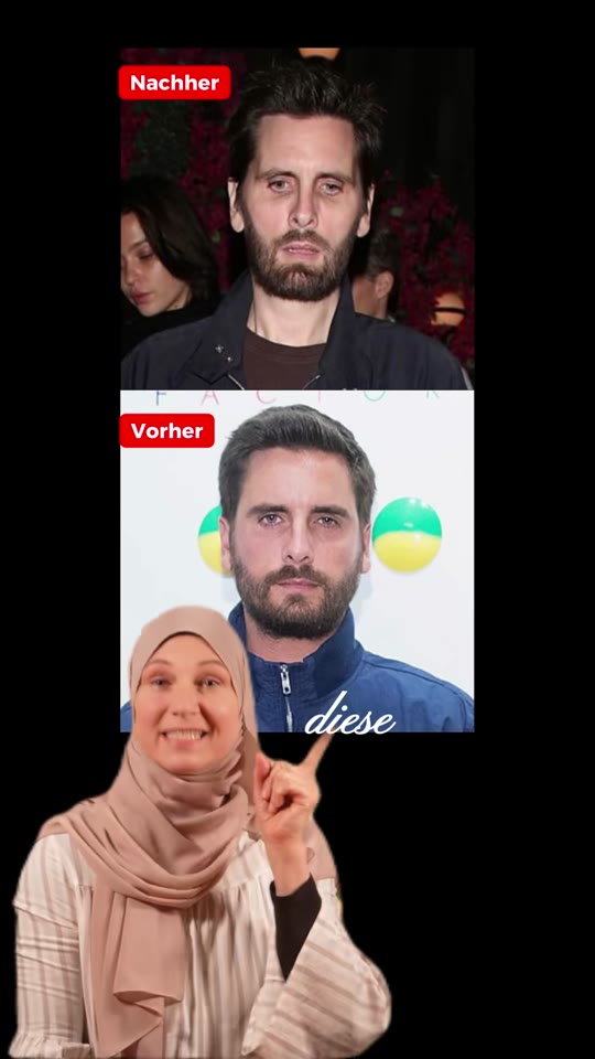Ozempic face is real, but the horror framing is overblown