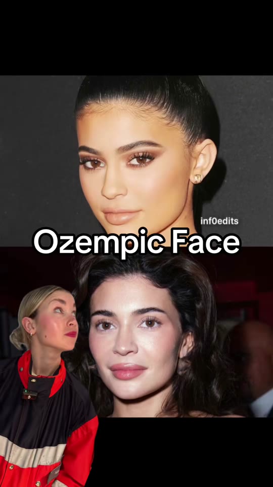 Ozempic face explained: what the science says about facial fat loss on semaglutide