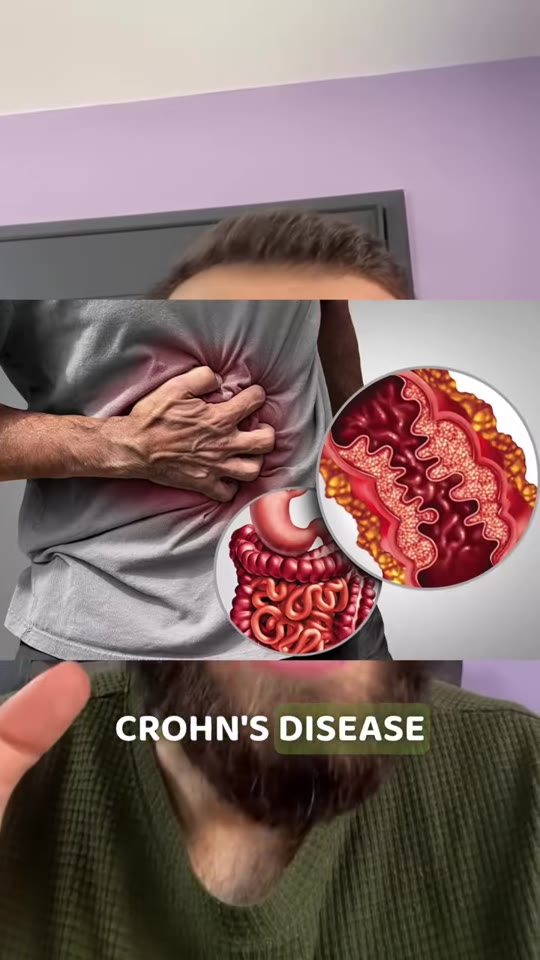 Zinc carnosine, L-glutamine, and Crohn's: separating signal from supplement hype