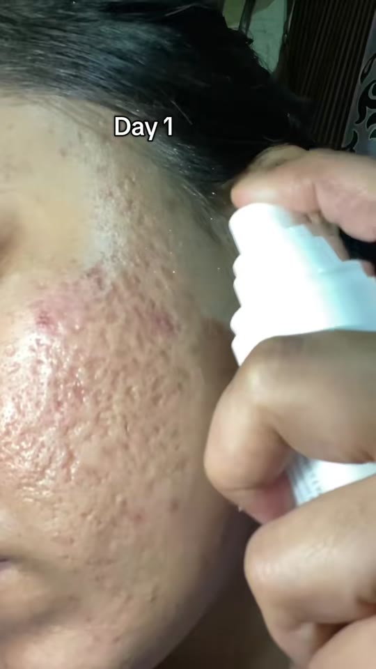GHK-Cu for acne marks and skin barrier: hype vs. evidence