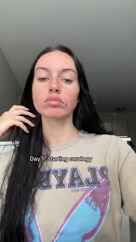 Curology for acne: what the science says about custom topicals