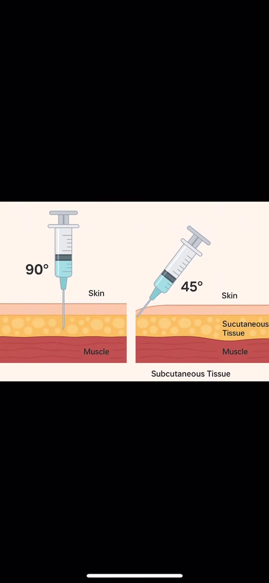 GLP-1 injection angle debate: Does 45° vs. 90° actually matter?
