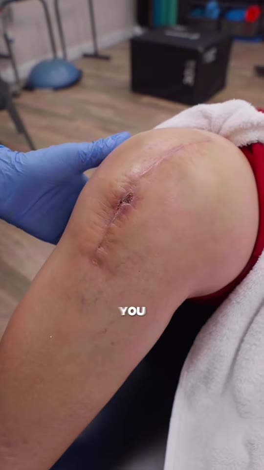 Peptides for knee replacement recovery: what the evidence shows