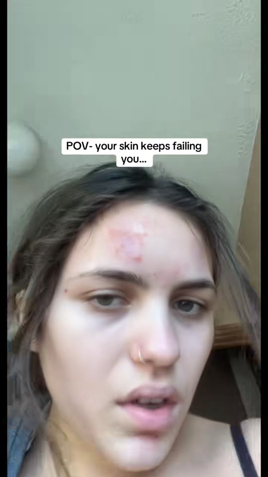Can peptides like BPC-157 actually treat cystic skin infections?