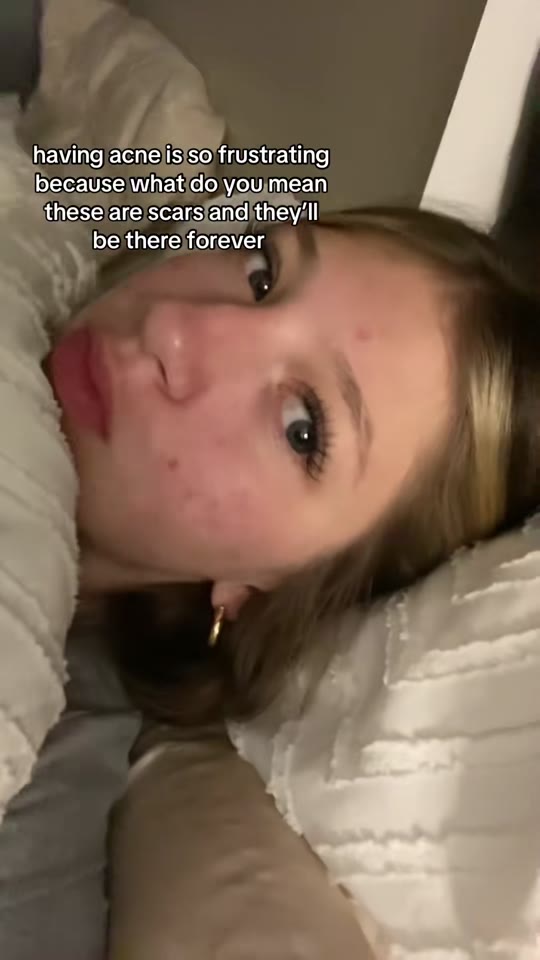 GHK-Cu and acne scars: what TikTok gets wrong about peptide skin healing