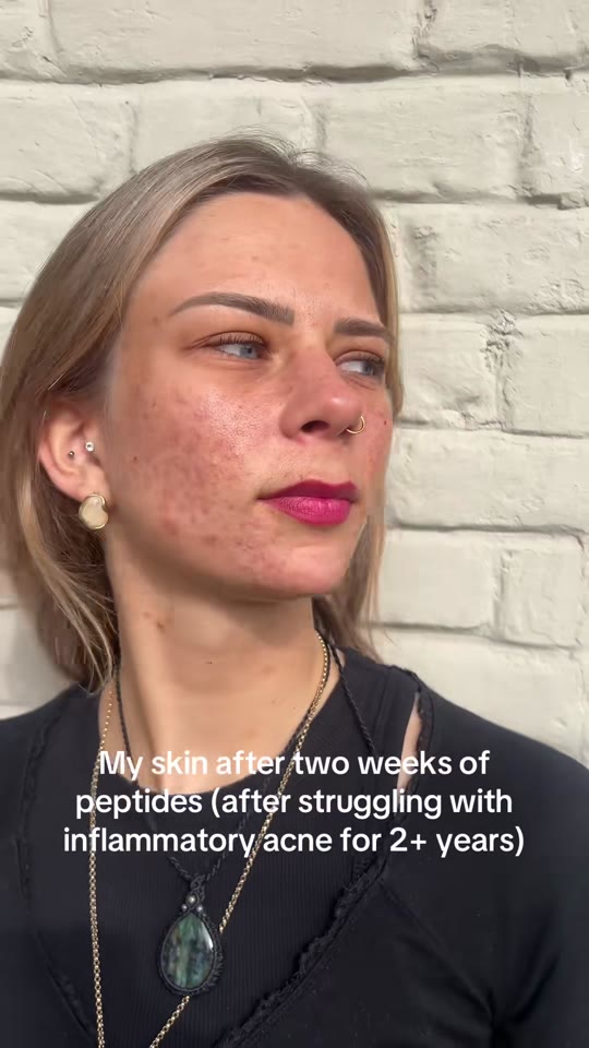 @_cvrxx's GHK-Cu peptide acne claims need context