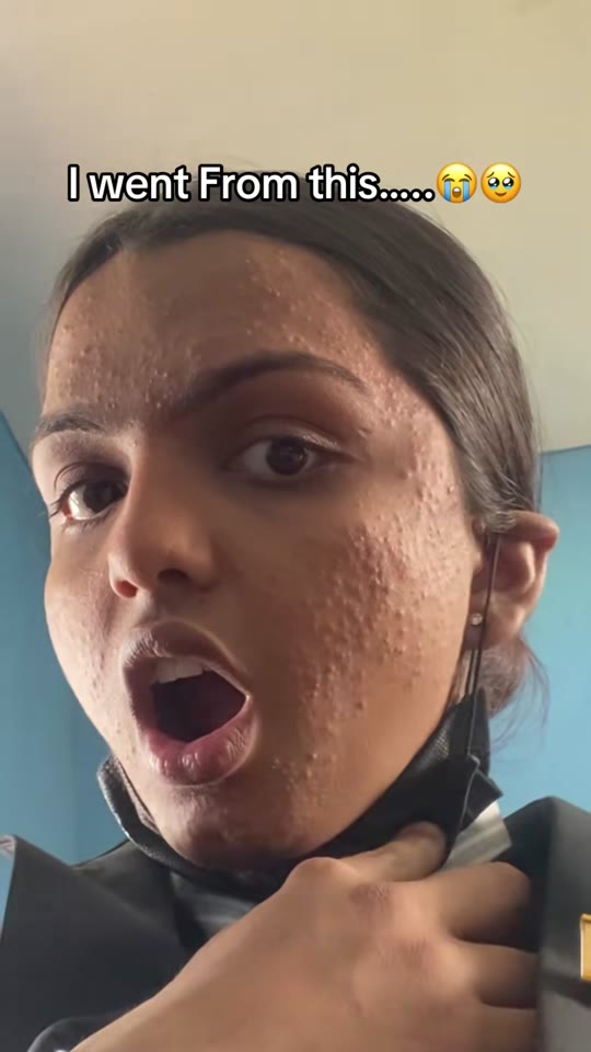 GHK-Cu and acne: what the peptide hype gets wrong