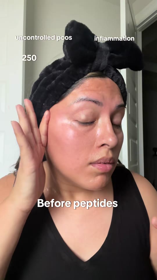Peptides for PCOS glow-ups: what the science actually supports