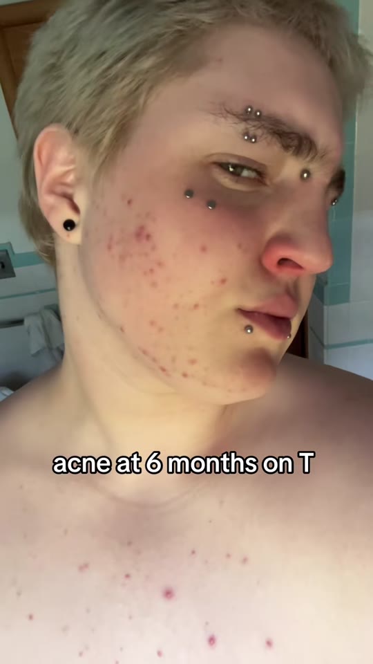 Testosterone and bacne: separating real risk from TikTok panic