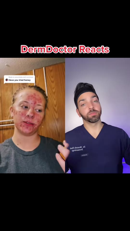 Dr. Shah's honey-for-acne advice doesn't match the science