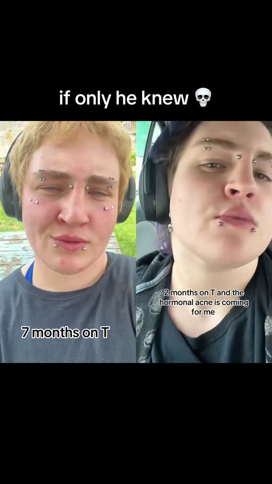 Testosterone and acne in FTM patients: what TikTok gets wrong