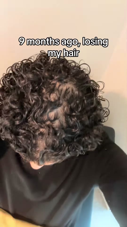 @benimtdollarsign's TRT hair regrowth claims, fact-checked