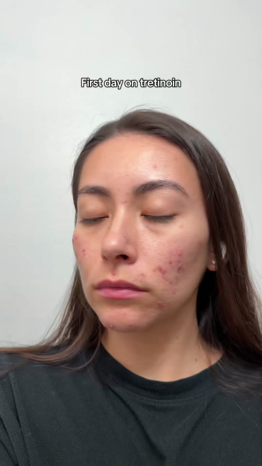 Tretinoin for acne: separating TikTok glow-ups from clinical reality