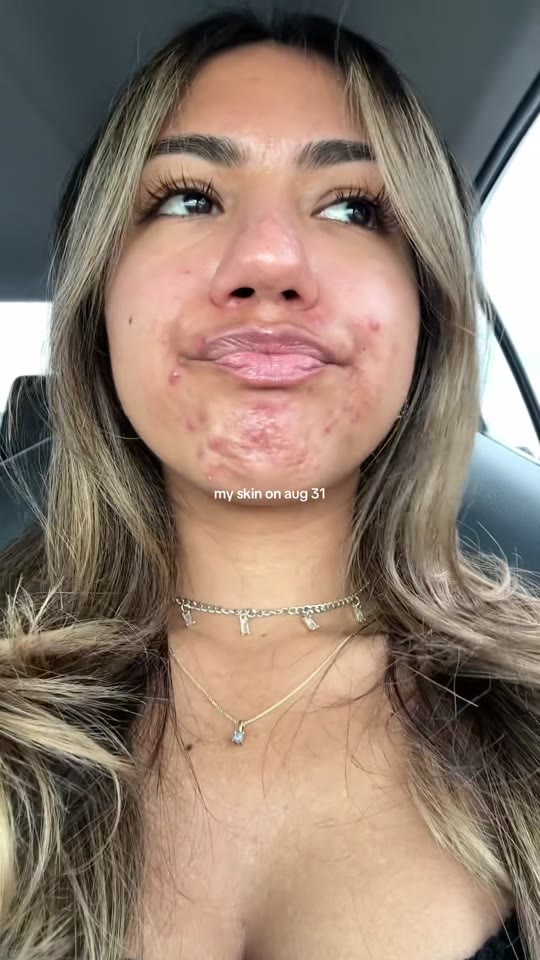 @muhlexy's tretinoin transformation claims, fact-checked