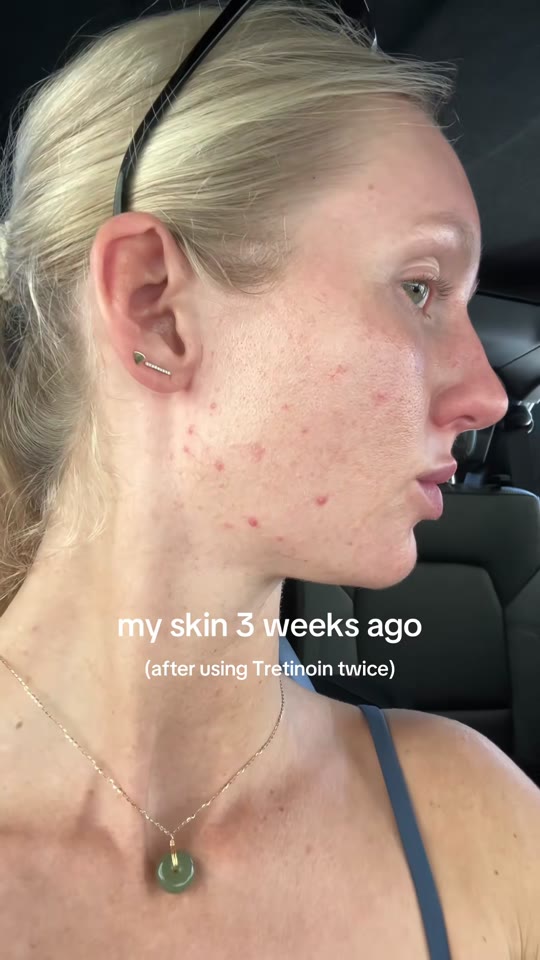 @clairealmondd's tretinoin tolerance claims, fact-checked
